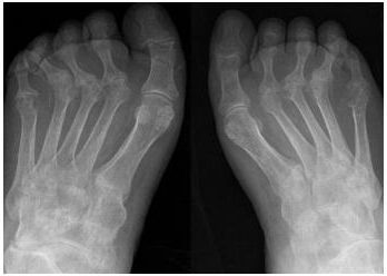 ankylosing spondylitis in feet