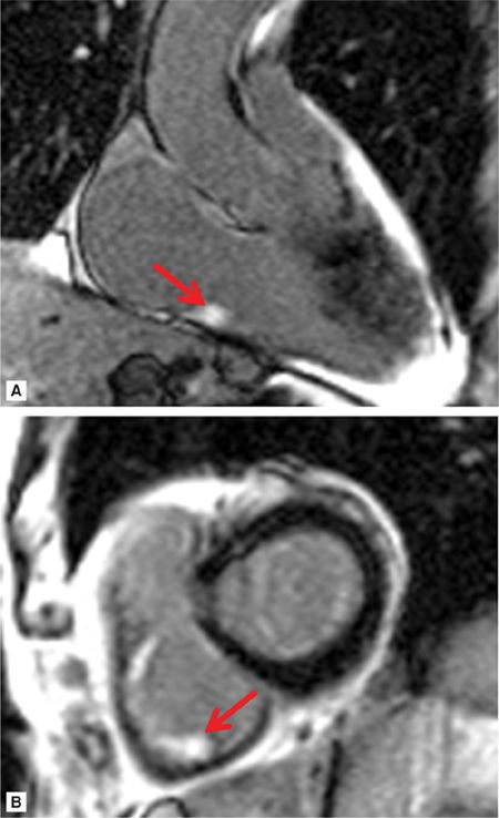 Cardiovascular Magnetic Resonance In Valvular Heart Disease | Radiology Key