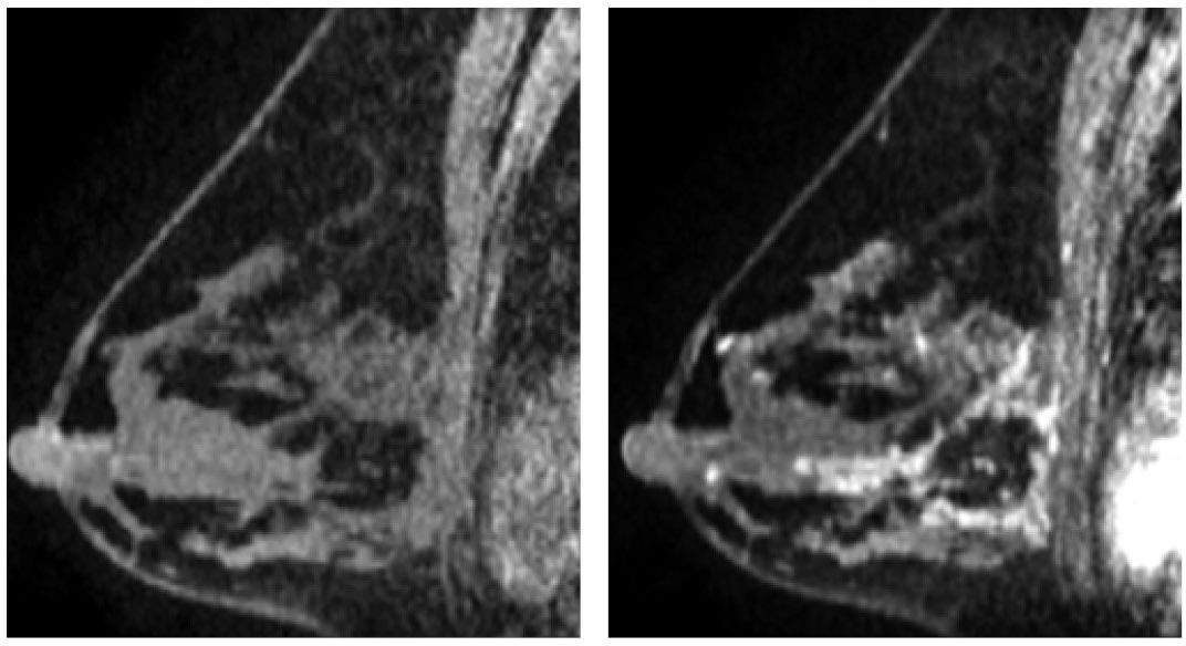 Breast Magnetic Resonance Imaging | Radiology Key
