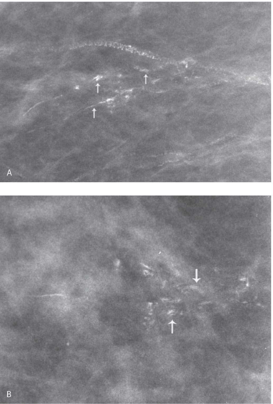 Breast Calcifications