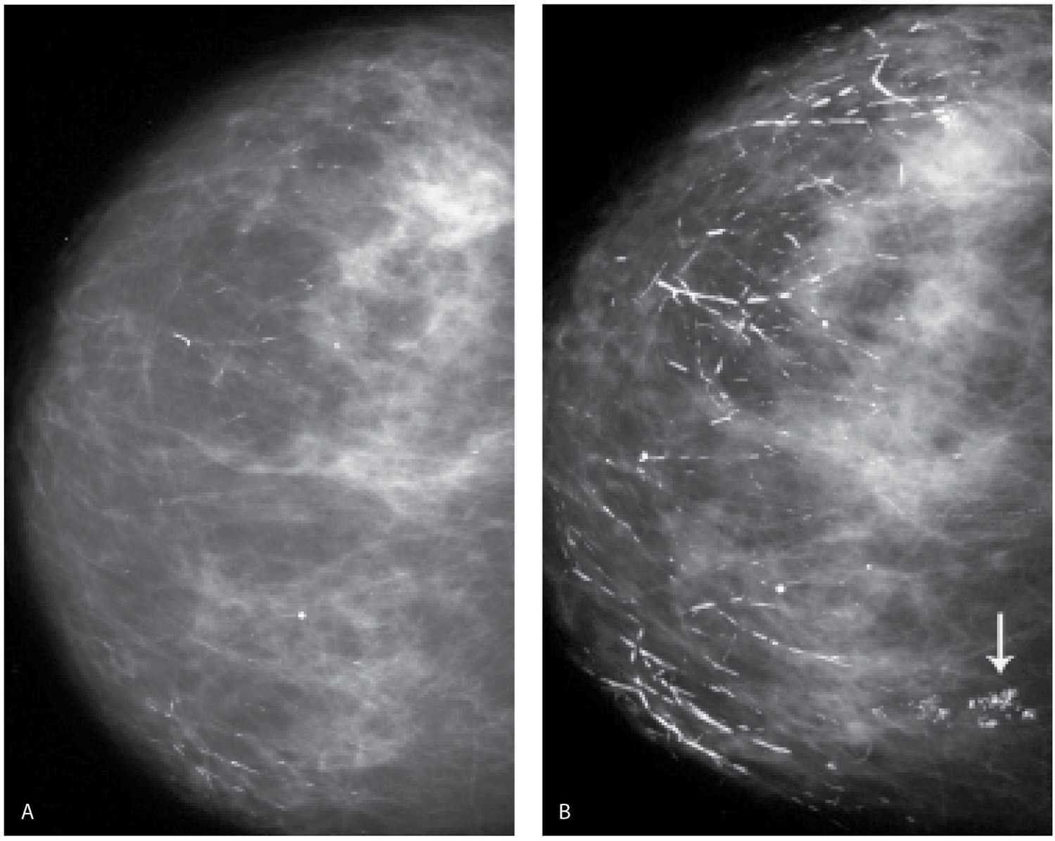 Картина фиброзных изменений. Маммография раковые микрокальцинаты. Линейные кальцинаты маммография. Микрокальцинаты при маммографии. Маммография кальцинаты доброкачественные.
