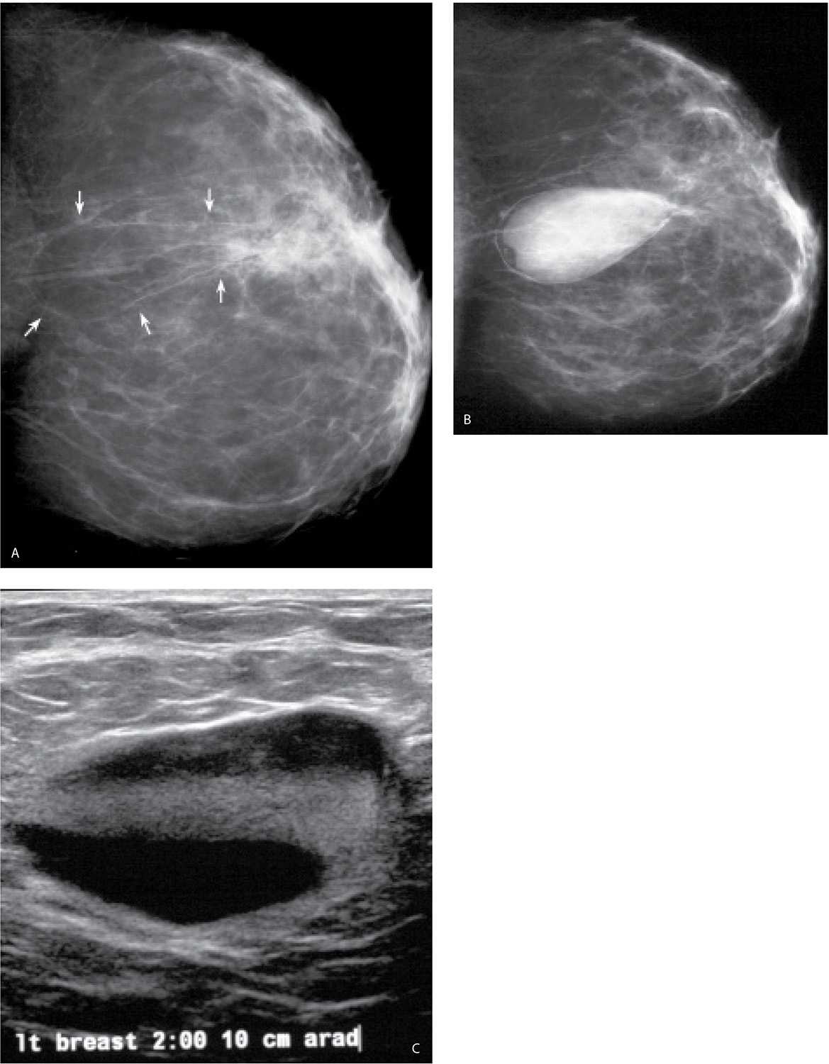 Bilateral mammogram shows mixed density glandular breast tissue with no