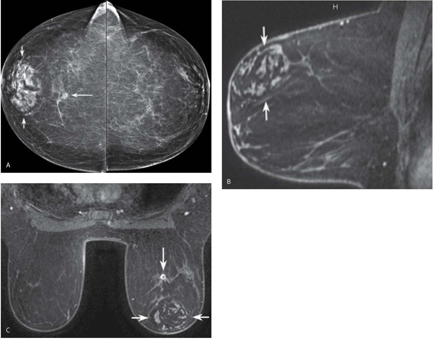 A‐D, Breast MRI, with bilateral multiple masses, two in the right and