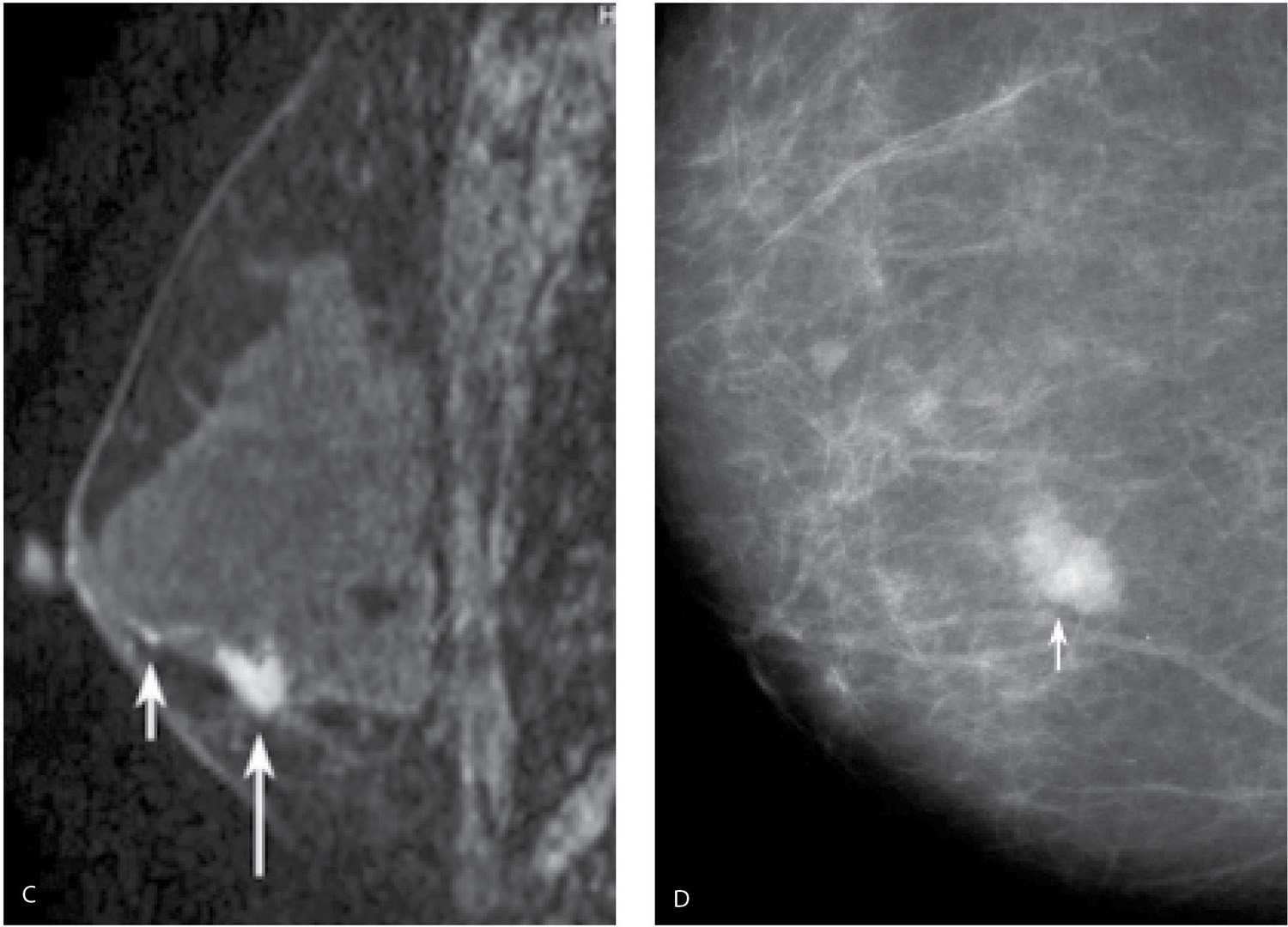 Calcified grade 3 solid DCIS in a 33-year-old woman with a palpable
