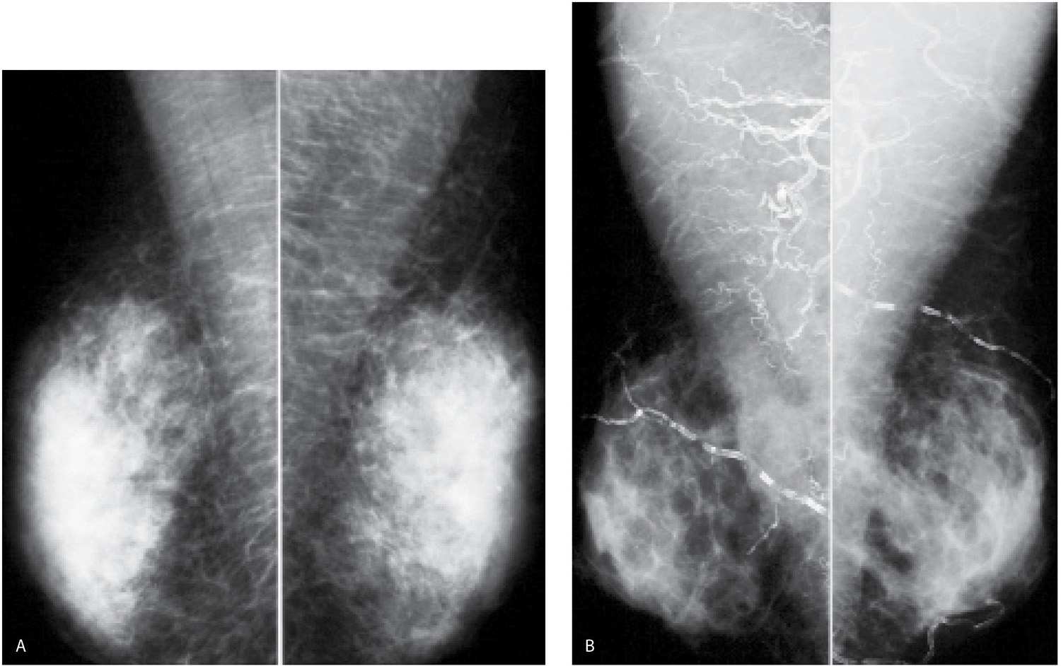 Breast mammogram showed bilateral benign gynecomastia, with the