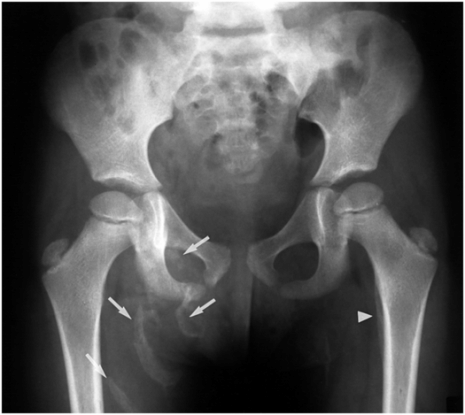 Lower extremity trauma | Radiology Key