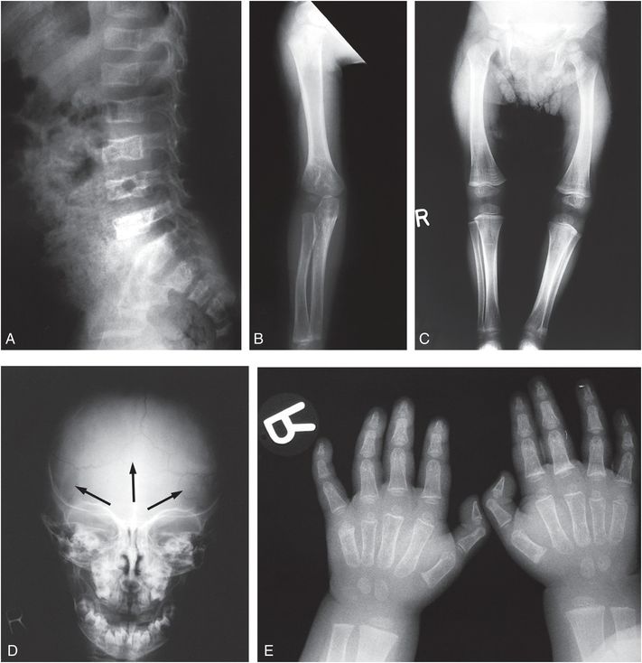 Types Of Osteogenesis Imperfecta Oi Brittle Bone Disease 5090