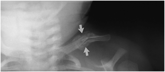 shoulder dystocia xray