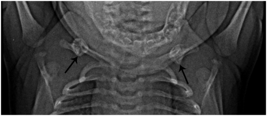 clavicle fracture newborn