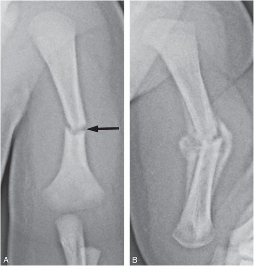 shoulder dystocia xray