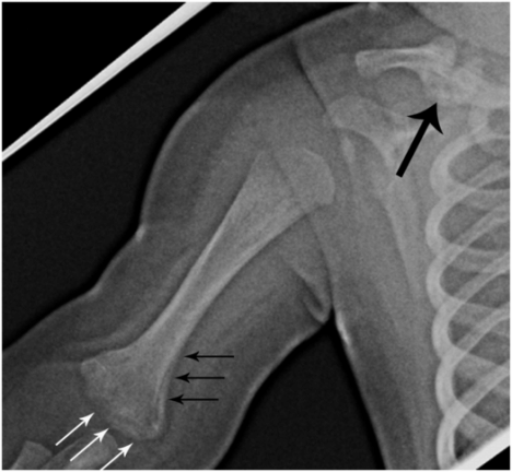 shoulder dystocia xray