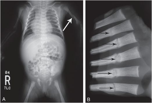 Miscellaneous Forms Of Abuse And Neglect Radiology Key