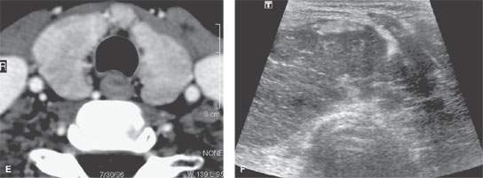 Thyroid Goiter Ultrasound