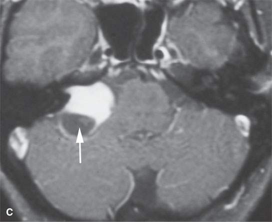 Benign And Malignant Peripheral Nerve Sheath Tumors Radiology Key 