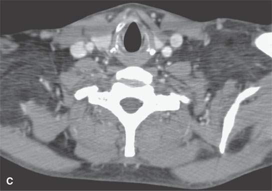 Benign and Malignant Lipogenic Tumors | Radiology Key