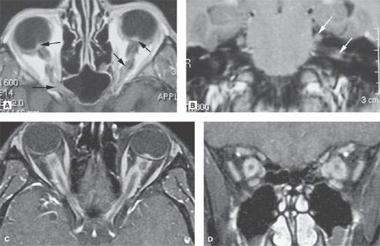 Optic Nerve And Sheath Benign And Malignant Tumors Radiology Key 
