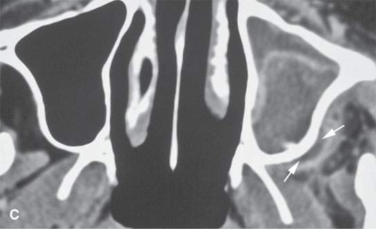 chronic sinusitis with nasal polyposis icd 10