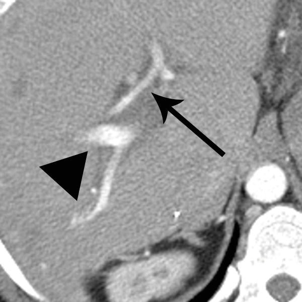 Liver | Radiology Key