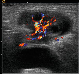 CDI of the Ovaries | Radiology Key