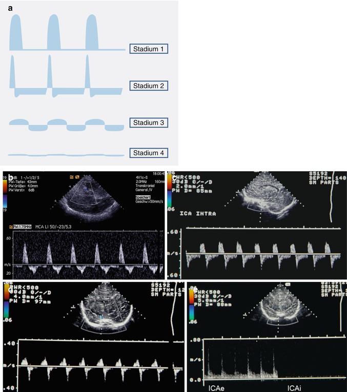 Cerebral Doppler Sonography | Radiology Key