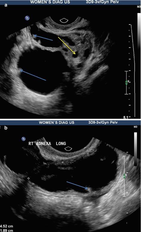 Ultrasound Imaging Of Gynaecologic Organs Radiology Key