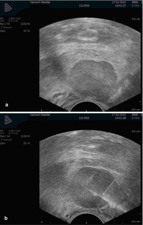 Endoanal Ultrasound Of Pelvic Floor Radiology Key