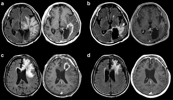 Brain Tumor: How Should We Manage Glioblastoma in the Era of IMRT ...