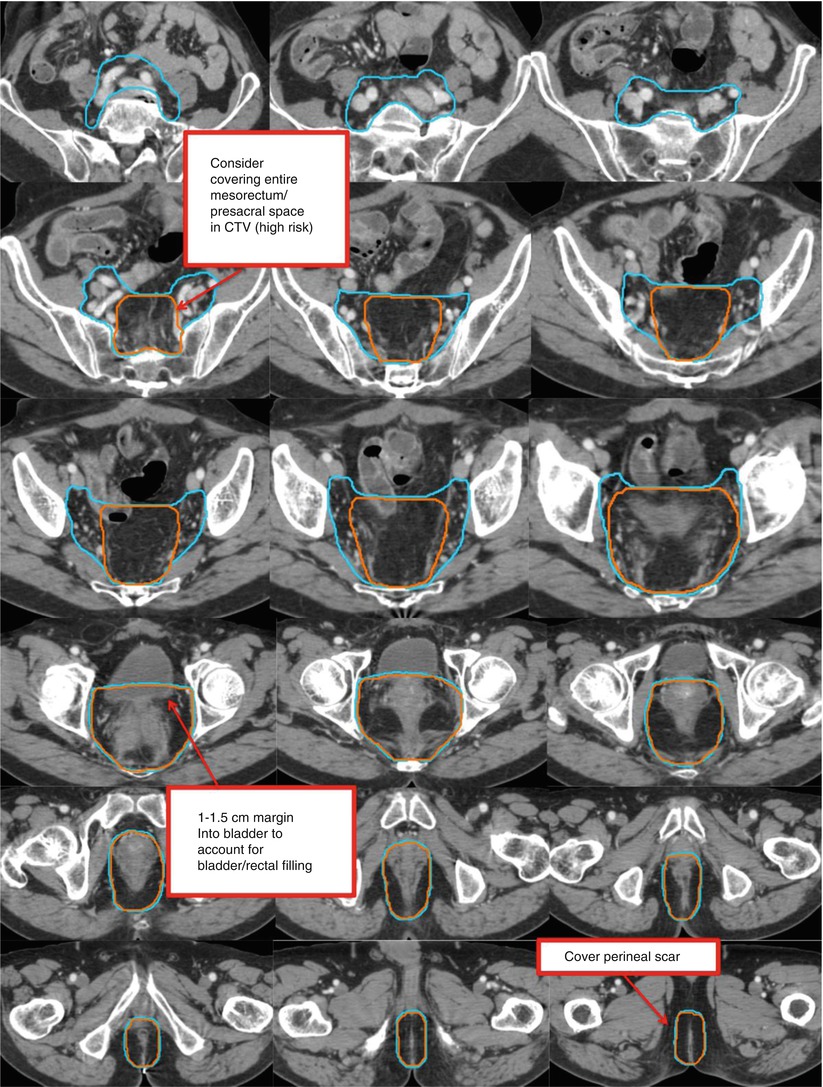 Cancer | Radiology Key