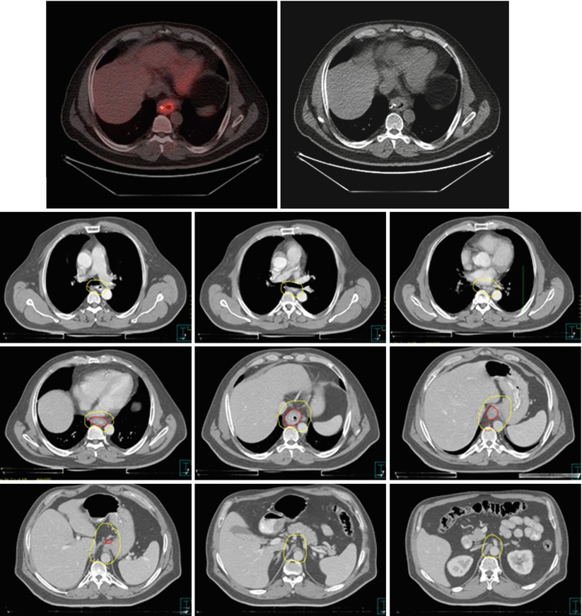 Cancer | Radiology Key