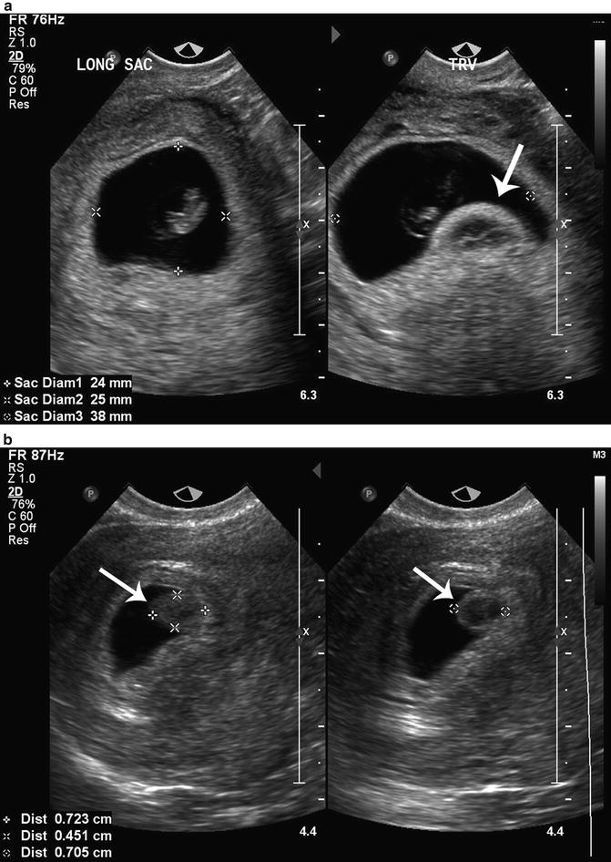 Amniotic Sac Ultrasound