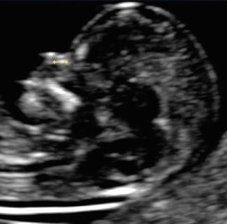 Fetal Biometry in Early Pregnancy | Radiology Key