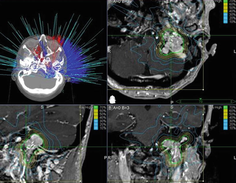 Skull Base Tumors Radiology Key 3274