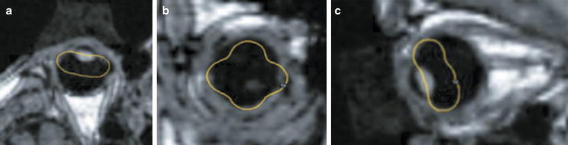 Ocular And Orbital Lesions | Radiology Key