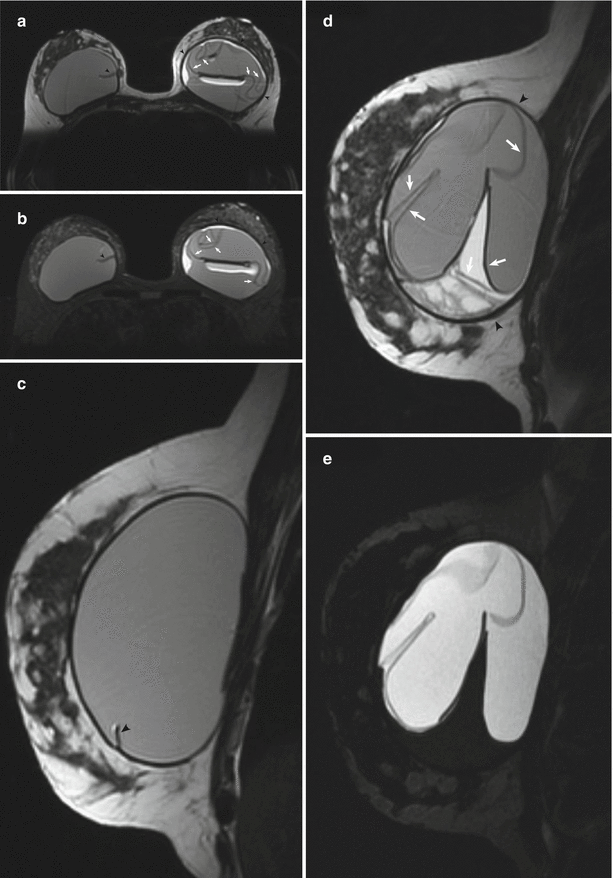 Breast Implants | Radiology Key