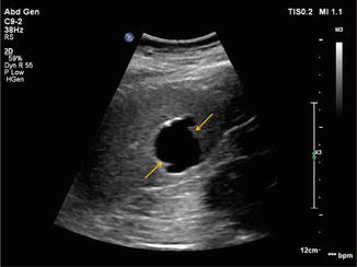 Liver Parasite Cyst Ultrasound