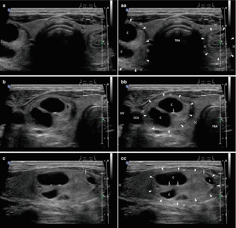 Albums 103+ Pictures Pictures Of Thyroid Nodules On An Ultrasound Superb