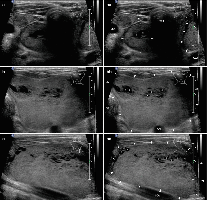 Multinodular Goiter Ultrasound Goiter Nontoxic Thyroid Gland