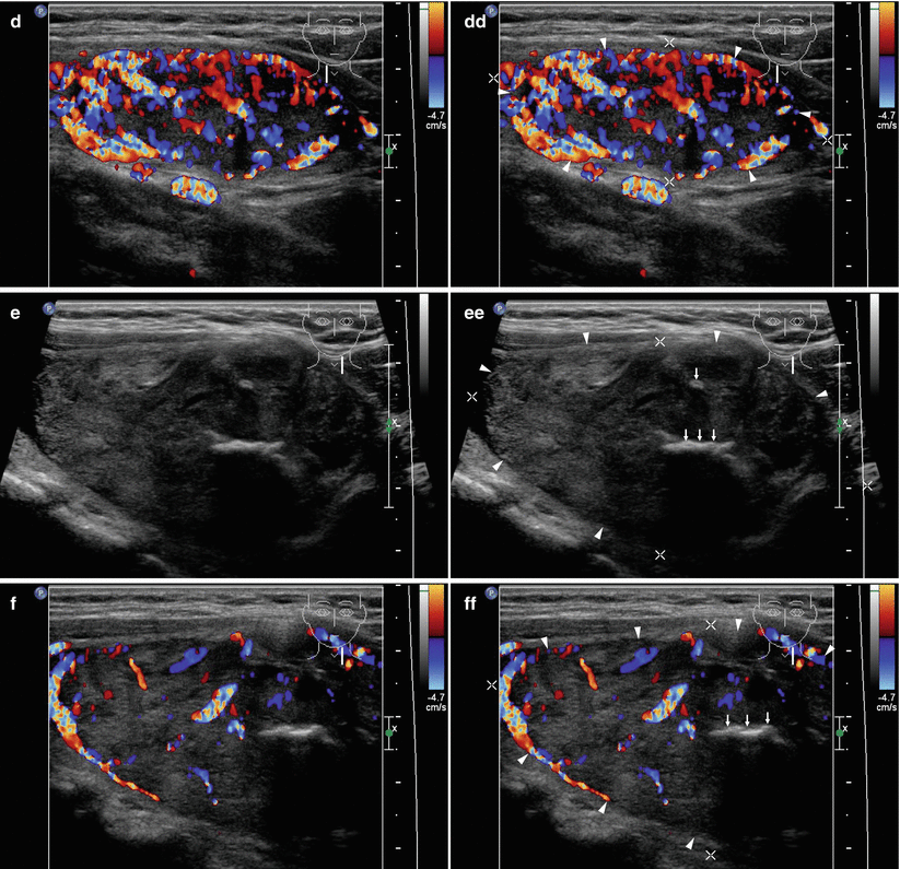 toxic-multinodular-goiter-and-solitary-toxic-adenoma-radiology-key