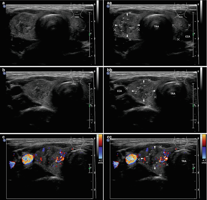 Papillary Thyroid Carcinoma | Radiology Key