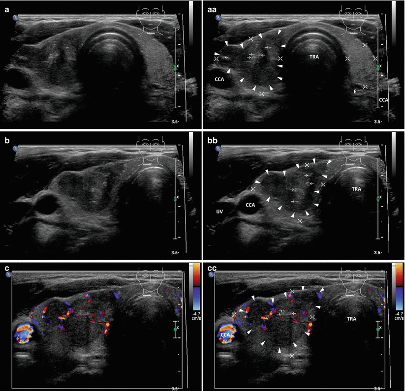 Papillary Thyroid Carcinoma | Radiology Key