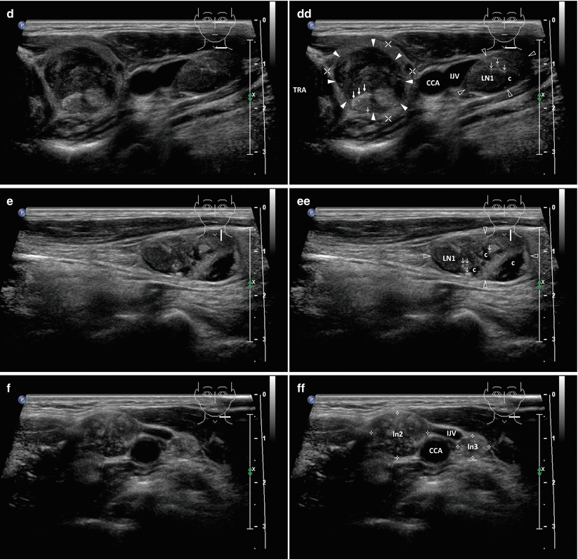 Papillary Thyroid Carcinoma | Radiology Key