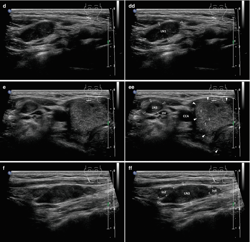 Papillary Thyroid Carcinoma | Radiology Key