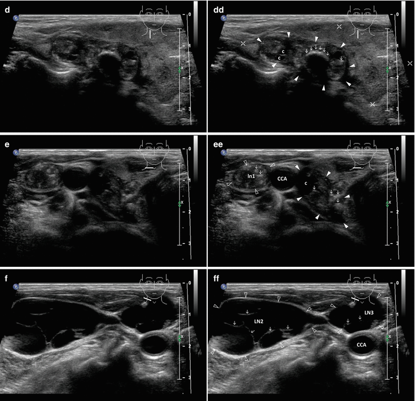 Papillary Thyroid Carcinoma | Radiology Key