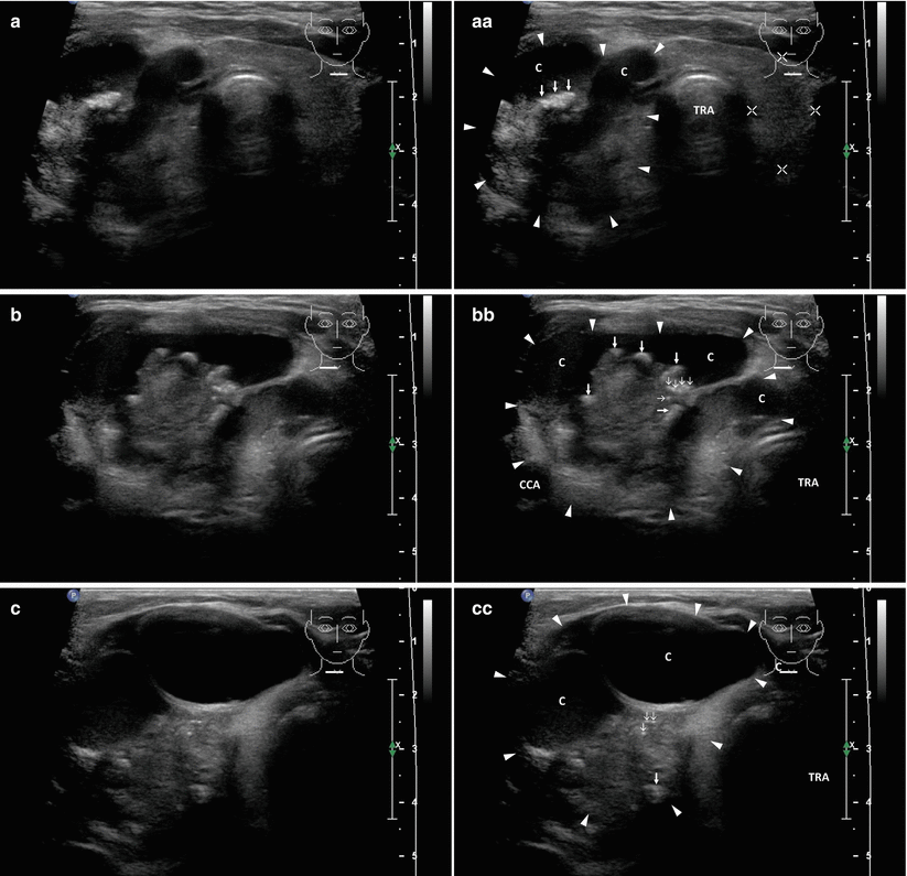 Papillary Thyroid Carcinoma | Radiology Key