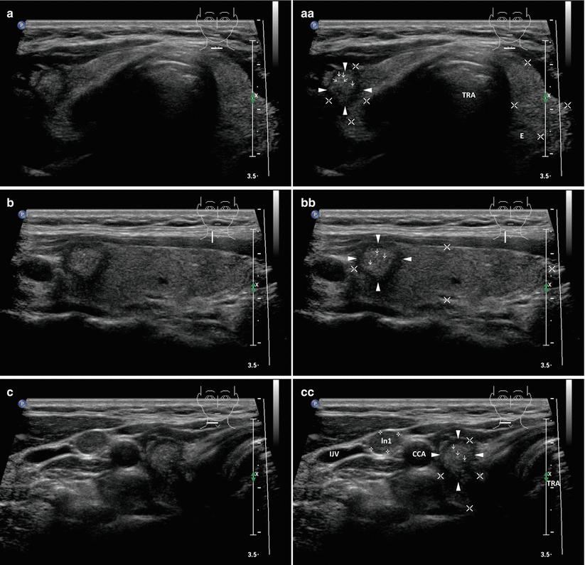 Papillary Thyroid Carcinoma | Radiology Key