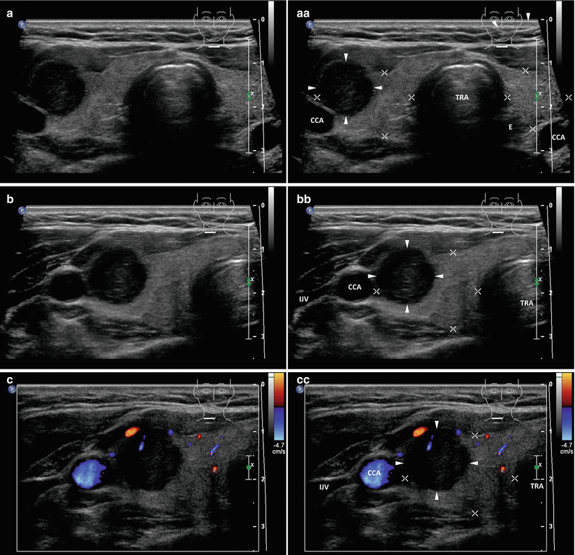 Papillary Thyroid Carcinoma | Radiology Key