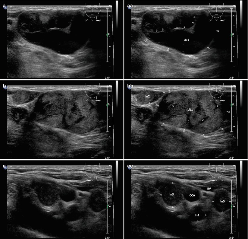 Normal Ultrasound Of Thyroid Gland And Lymph Nodes Radiology Key