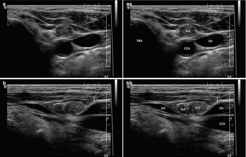 Metastatic Cervical Lymph Nodes Post Total Thyroidectomy for Thyroid ...