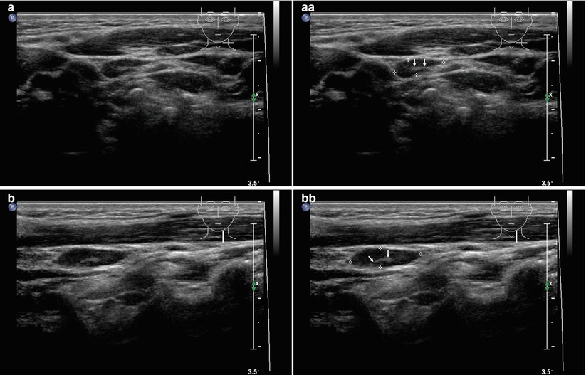 Normal Ultrasound of Thyroid Gland and Lymph Nodes | Radiology Key