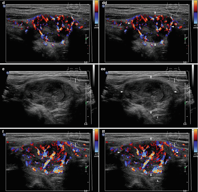 Thyroid Tissue Remnants Post Thyroidectomy | Radiology Key